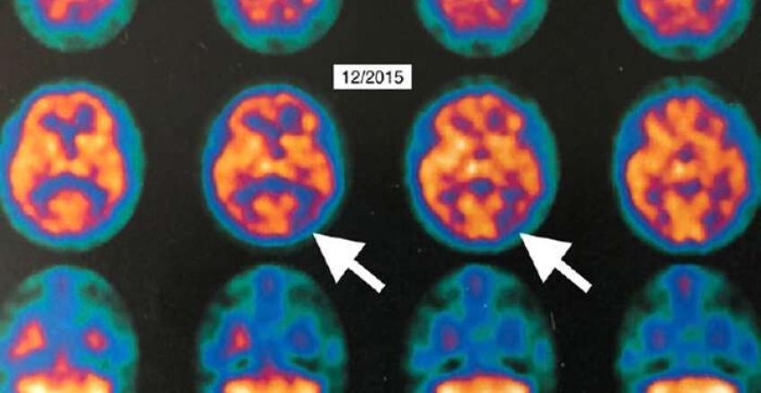 Un sistema informático permitirá identificar células asociadas al Alzheimer &quot;en tiempo récord&quot;